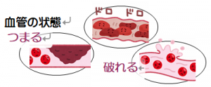 詰まった血管